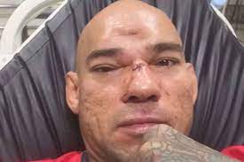 Com Afundamento De Cranio Cyborg Promete Justificar Apelido E Voltar A Lutar Em Seis Meses Superesportes