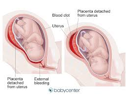 How would you know if your water was leaking? Leaking Amniotic Fluid Premature Rupture Of Membranes Babycenter