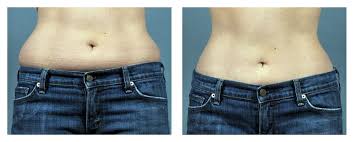 Tickle Lipo Power Assisted Liposuction Exposed Abs Workout For Women Lipo Lipo Before And After