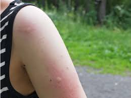 The bite feels like a pinprick, so you may not notice it. Signs A Bug Bite Is Serious Warning Signs