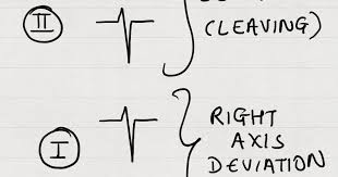 Image result for Left Axis Deviation