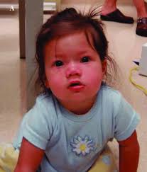 Epicanthal folds are normal in asians like in native americans and in korean population. Patient Features Pictures Were Taken At 15 Months A And 12 Years 8 Download Scientific Diagram