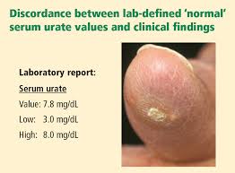 Image result for Hyperuricemia