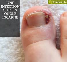 We did not find results for: Guerir Prevenir Les Ongles Incarnes Le Tout Naturellement
