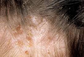 Bug Bites Pictures Slideshow Identifying Bugs And Bug Bites Head Lice Infestation Lice Infestation Head Louse
