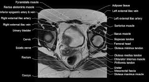 This mri male pelvis axial cross sectional anatomy tool is absolutely free to use. Mri Female Pelvis Anatomy Axial Image 19 Pelvis Anatomy Rectus Abdominis Muscle Pelvis