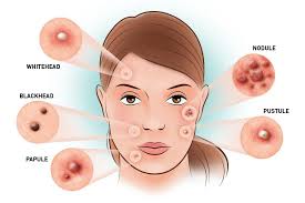 Memencet jerawat menjadi kekeliruan yang sering dilakukan oleh banyak orang. Blogtipz4u Ini Cara Menghilangkan Bekas Jerawat Secara Alami Tanpa Obat Obatan