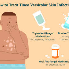 Skin yeast infection and yogurt. Best Treatments For Tinea Versicolor Skin Infection