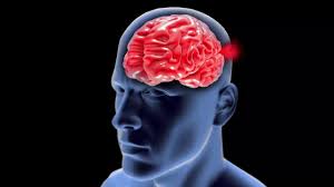 An aneurysm is a bulging, weakened area in the wall of a blood vessel resulting in an abnormal the most common location of an aneurysm is the aorta, which carries oxygenated blood from the heart to. Are You At Risk For A Ruptured Brain Aneurysm Youtube