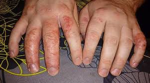 De fleste mærker ikke noget til det selv, bortset fra at de kan. Mrsa Smitte Er Ingen Sygdom Mener Arbejdsskadestyrelsen Men Mrsa Eksem Er Gylle Dk