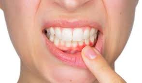 التهاب دواعم السن Periodontitis كل يوم معلومة طبية