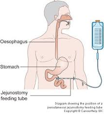 J Tube To Help Us Eat After Sjogrens Has Caused Severe Gastroparesis It Bypasses The Stomach Km Sjogrens Gastroparesis Sjogrens Syndrome