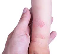 Image result for Atopic eczema atopic dermatitis