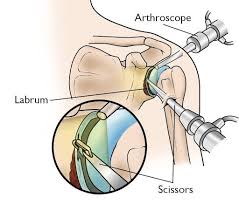 Image result for SLAP Lesion