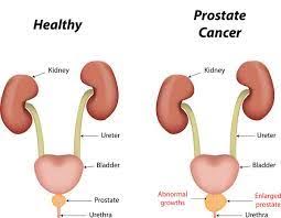 Pin On Prostate Problems