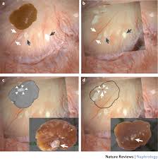 Image result for Calcium Nephrolithiasis