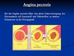 Herz Kreislauferkrankungen Ppt Video Online Herunterladen