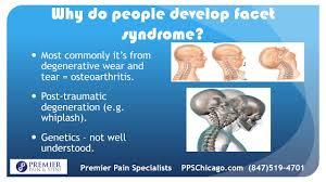 Mar 05, 2020 · neck (cervical) pain is a common condition that often becomes chronic in nature, with prevalence ranging from 30% to 50% over the course of 12 months. Facet Syndrome And Arthritis