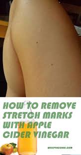 Pin On Apple Cider Vinegar