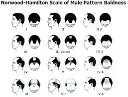 Classifications Of Hair Loss Armani Medical