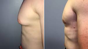 181 views · answer requested by Male Breast Reduction Hawaii Honolulu Gynecomastia Dr S Larry Schlesinger