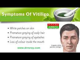 Ayurvedic Vitiligo Treatment In Kochi White Patches Treatment In Kerala Vitiligo Treatment India Youtube