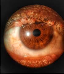 Image result for HIV Retinitis