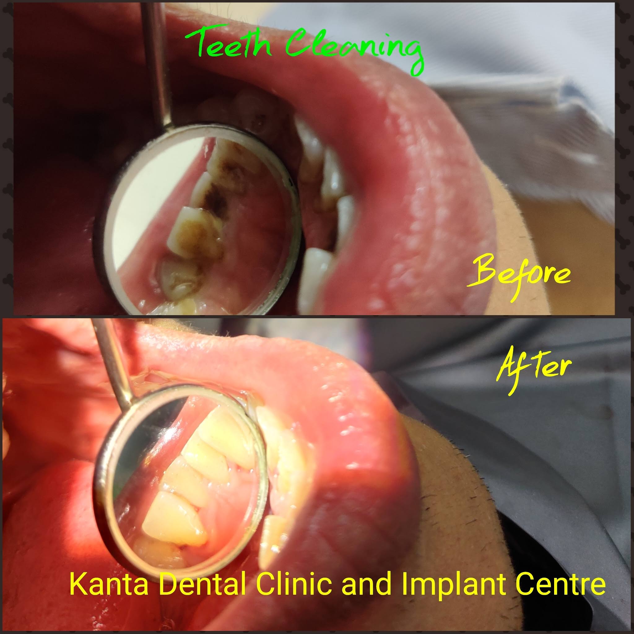 Teeth Cleaning and Polishing product image