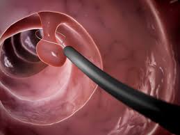 Pin On This Is A Colon Polyps Looks Like Very Serious If They Mutate