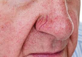 How can you make veins more prominent? How Can I Get Rid Of The Spider Veins On My Face Health Essentials From Cleveland Clinic