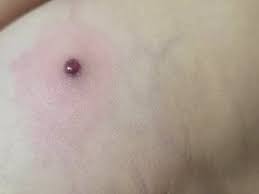 Image result for spinne biss haut reaktion