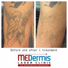 What does 50 cent's tattoos mean? How To Get Rid Of A Stick And Poke Tattoo Medermis Laser Clinic