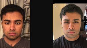 Recent changes dr_yaremchuk's in instagram account. Custom Wrap Around Peek Jaw Implant Results Curry Ascension Page 2 Looks Theory