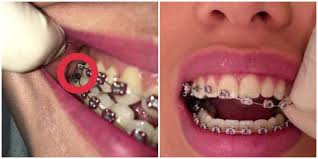 So kenalah tambah satu lagi aksesori berus gigi. Fake Braces Berisiko Dijangkiti Hiv