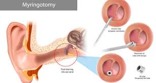 Image result for Mastoiditis