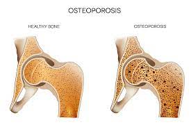 Osteoporosis Symptoms & Treatment | Advocate Health Care