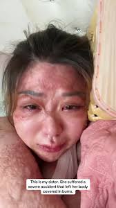 Support for Burn Survivors: A Sister's Heartfelt Journey