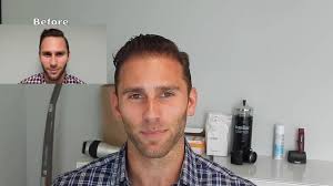 Discover 29 Natural Transplants, Hair Restoration Clinic and hair doctor  ideas