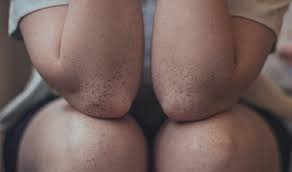 Image result for liver spots on legs