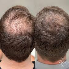 Understanding Hair Transplantation Techniques