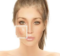 Image result for demodex rosacea