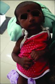 56 Day Old Full Term Infant Diagnosed With The Pierre Robin Sequence Download Scientific Diagram