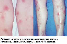 Эритема узловатая — это поражение подкожных и кожных сосудов, имеющее аллергическое происхождение и чаще всего эритема узловатая находится на симметричных участках ног. Uzlovataya Eritema Klinicheskaya Kartina Diagnostika I Lechenie Zabolevaniya Estet Portal