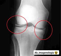 Calcificación de los cartilagos de la rodilla (condrocalcinosis)