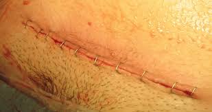 C Section Incision Yeast Infection Treatment Que Yucg Hmgroup Pro