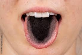 Image result for black tongue symptoms