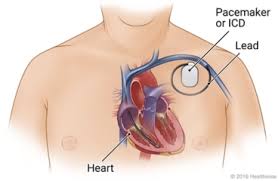 A pacemaker helps control abnormal heart rhythms. Pacemaker Or Icd Replacement What To Expect At Home