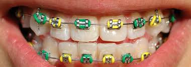 They may also occur after the regular this type of braces pain usually appears for the first days to a week after the initial braces placement and after each time the braces get tightened in. How To Stop Braces Pain Other Braces Problems Electric Teeth