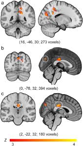 Over time, brain cells affected by alzheimer disease also begin to shrink and die. Apoe E4 Selectively Modulates Posteromedial Cortex Activity During Scene Perception And Short Term Memory In Young Healthy Adults Scientific Reports