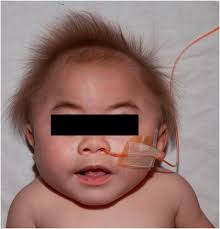 Widens like the end of a hockey stick and ends between the second and third fingers. Visual Diagnosis 9 Month Old Boy With Coarse Facial Features And Hepatosplenomegaly American Academy Of Pediatrics